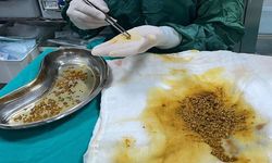 Safra kesesinden 2 bin 67 taş çıkarıldı