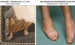 1800 yıllık Zeugma mozaiğinde tıbbi iz