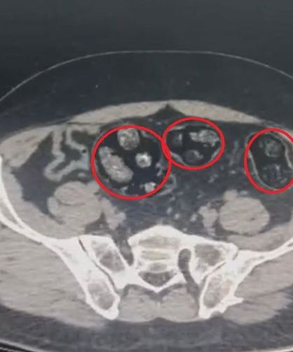 Yolcunun midesinden 62 parça uyarıcı madde çıktı