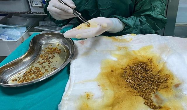 Safra kesesinden 2 bin 67 taş çıkarıldı